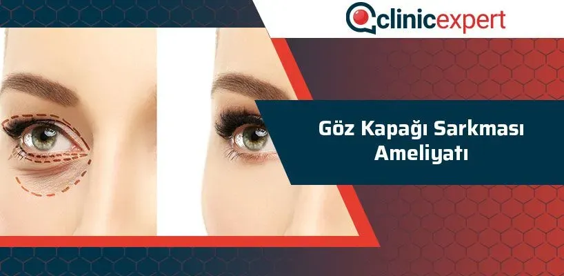 Göz Kapağı Sarkması: Sağlık Riskleri ve Çözüm Yöntemleri