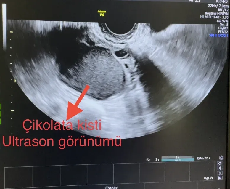 Çikolata Kisti: Belirtileri ve Tedavi Yöntemleri