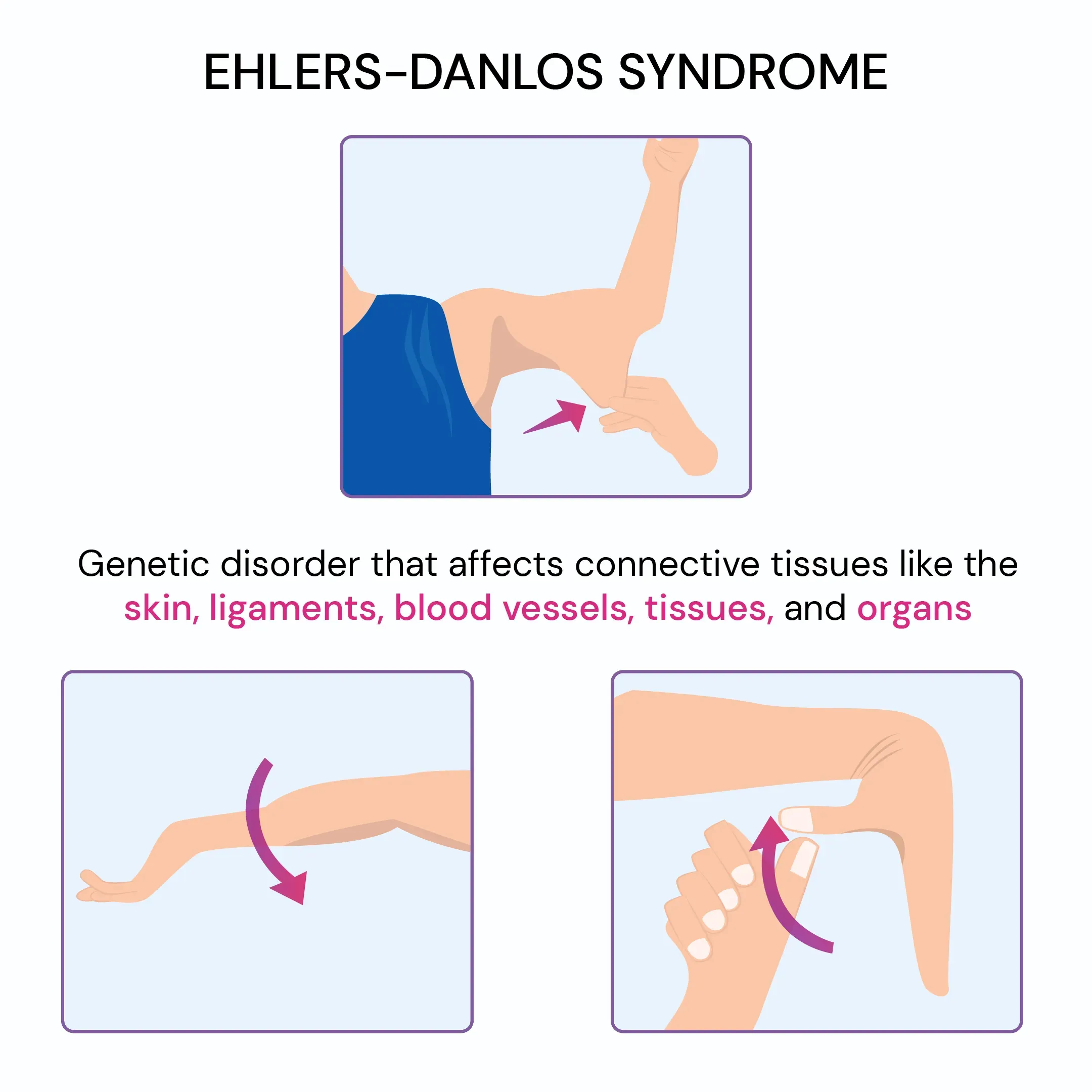 Ehlers-Danlos Sendromu: Solunum Sağlığını Tehdit Ediyor