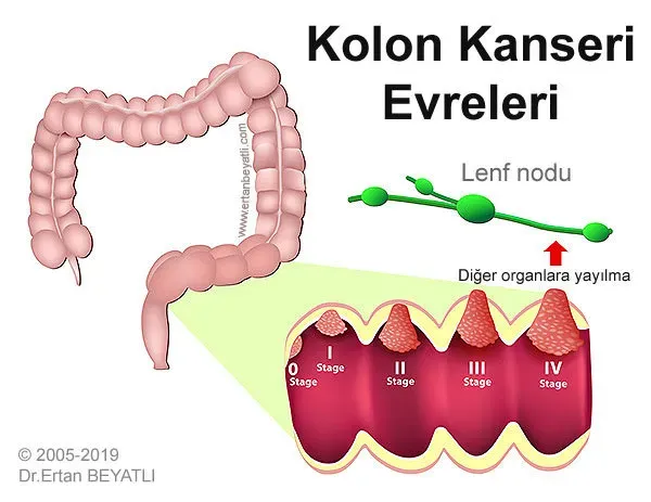 Kolon Kanseri: 4. Evre Teşhisiyle Yaşamla Savaş