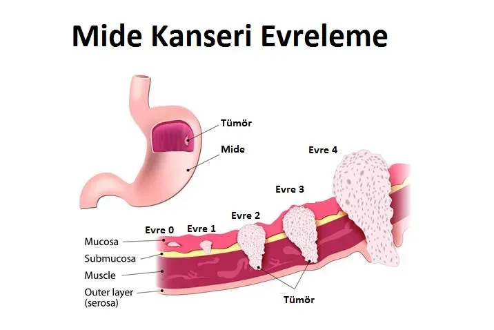 Mide Kanseri: A Kan Grubu ve Risk Faktörleri