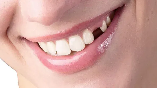 Diş Kaybı: Nedenleri ve Çözüm Yolları Hakkında Bilgi
