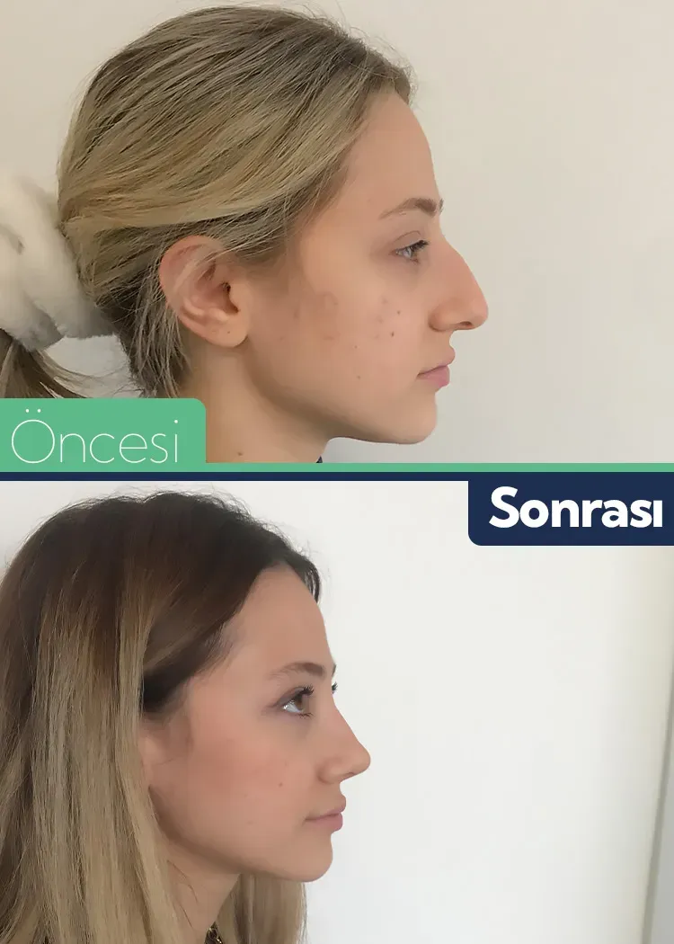 Burun Estetiği: Sık Sorulan Sorular ve Cevaplar