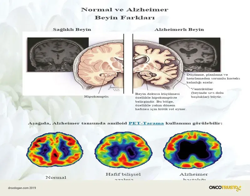 Alzheimer Hastalığı: Erken Belirtileri ve Önleme Yöntemleri