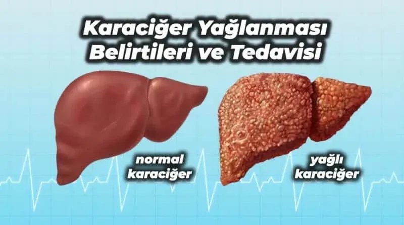Karaciğer Yağlanması: Bel Çevresine Dikkat Edin