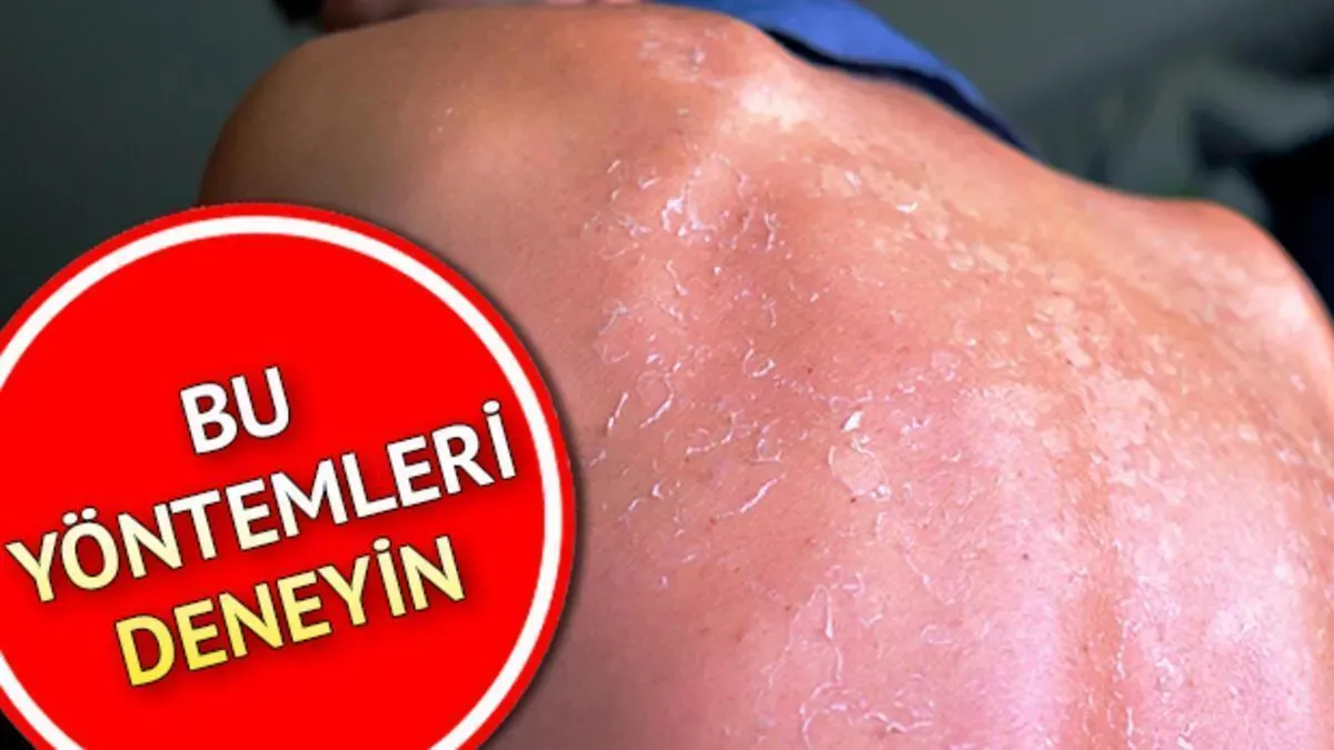 Güneş Yanığı: Melanom Riskini İki Kat Artırıyor