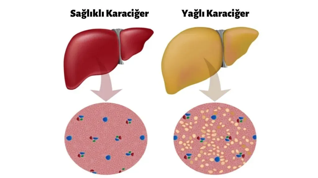 Karaciğer Sağlığını Bozan Besinler ve Etkileri