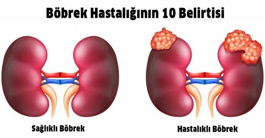 Böbrek Hastalığı Belirtileri: Sağlığınızı Kontrol Edin