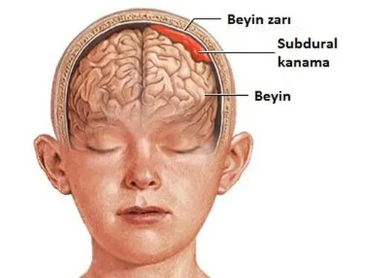 Beyin Kanaması Belirtileri: Nedenleri ve Tedavi Yöntemleri