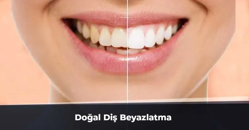 Doğal Diş Beyazlatma: Basit Yöntemlerle Gülümseyin